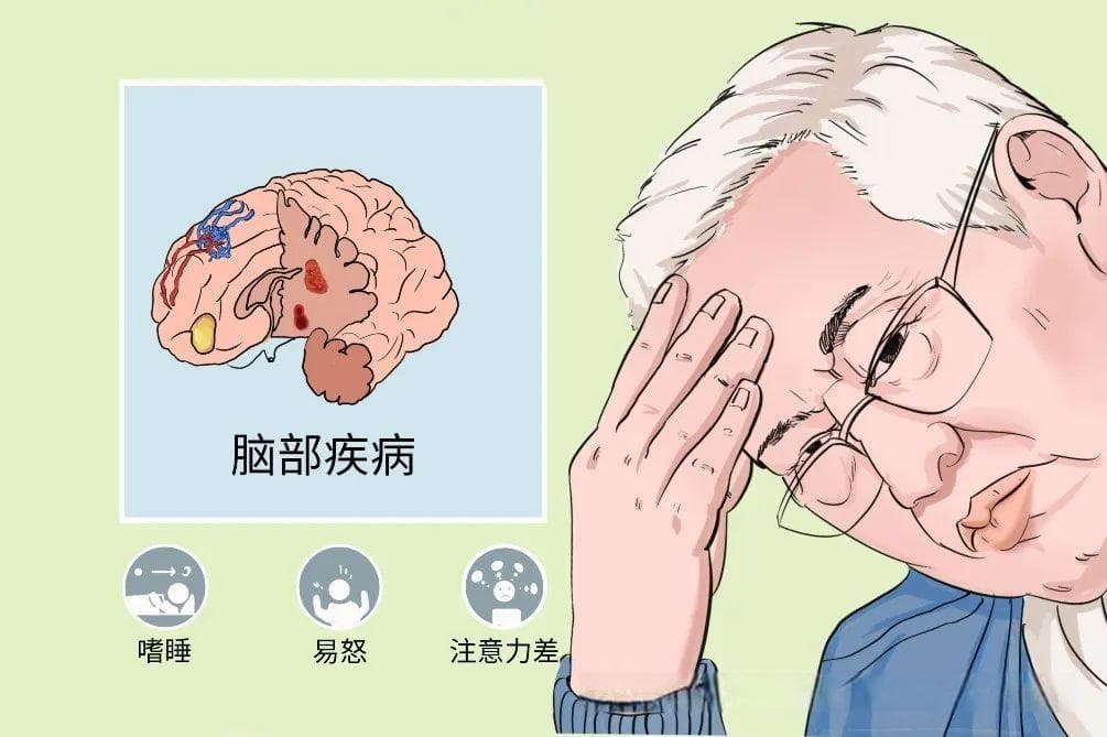 神经系统疾病伴发睡眠障碍研究新进展