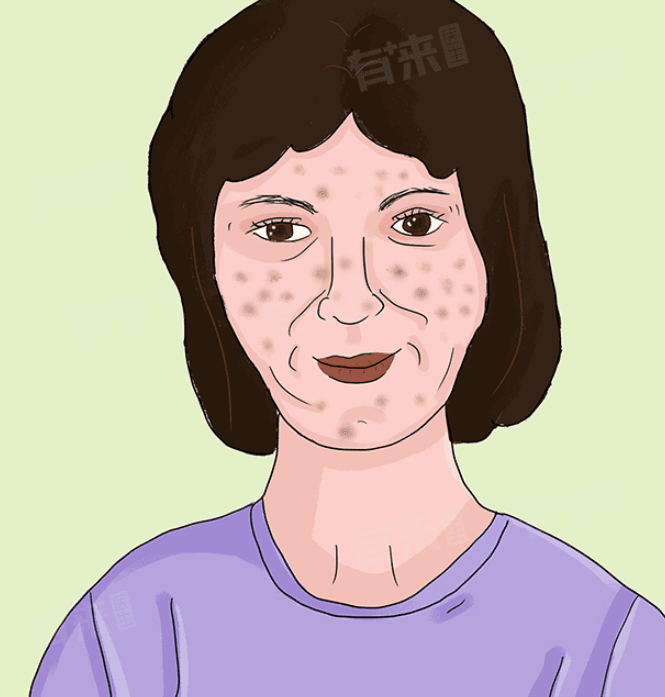 黄褐斑是什么样的