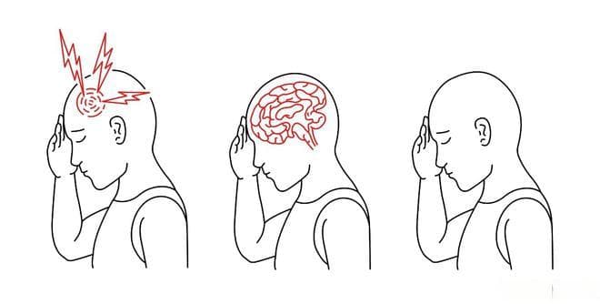 癫痫反复发作记忆力差、影响大脑，要怎么“补脑”？