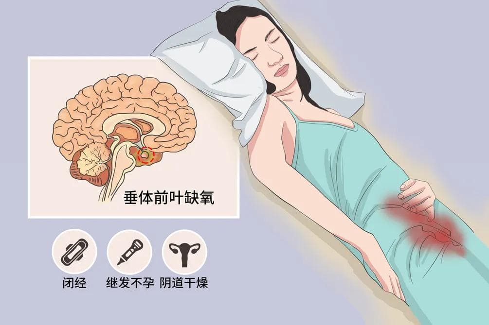 席汉综合征
