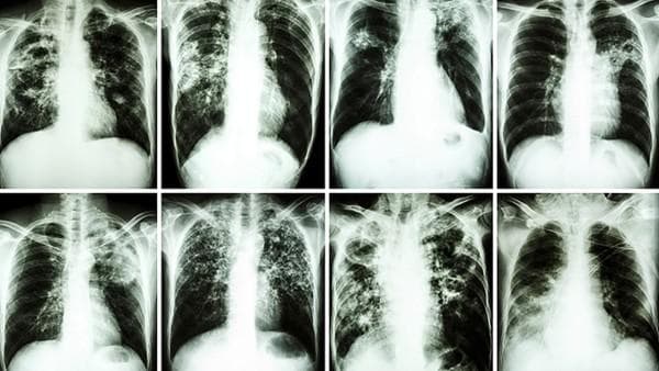 中医怎样医治大肠癌的病因