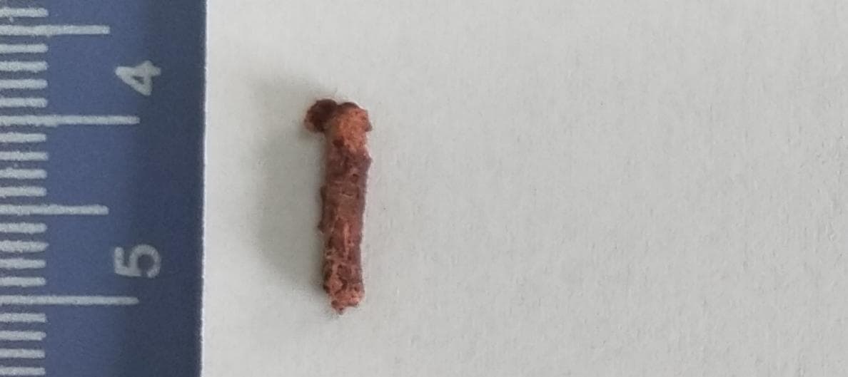 骨髓活检知多少？