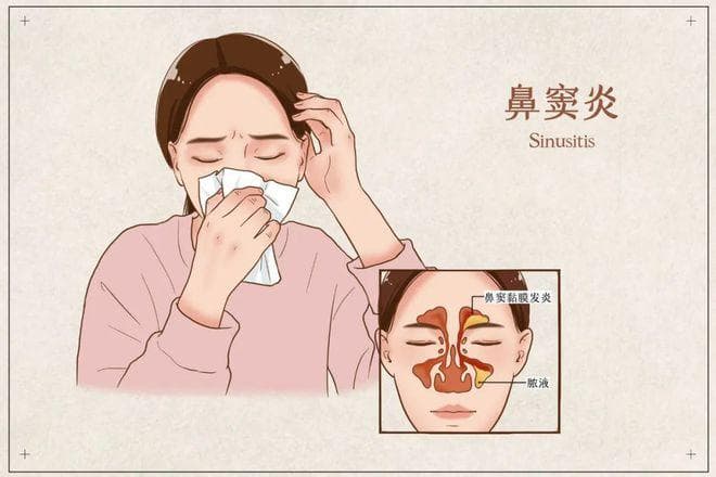 你是一名鼻窦炎患者吗？点进来看怎么防怎么治