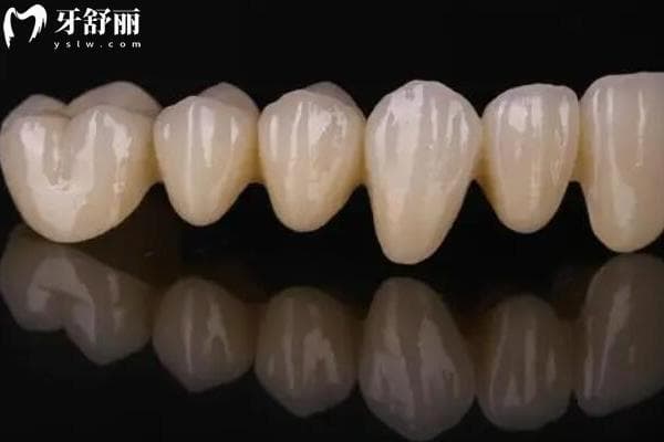 全瓷牙的寿命是几年？10-20年左右|实际寿命受多种因素影响