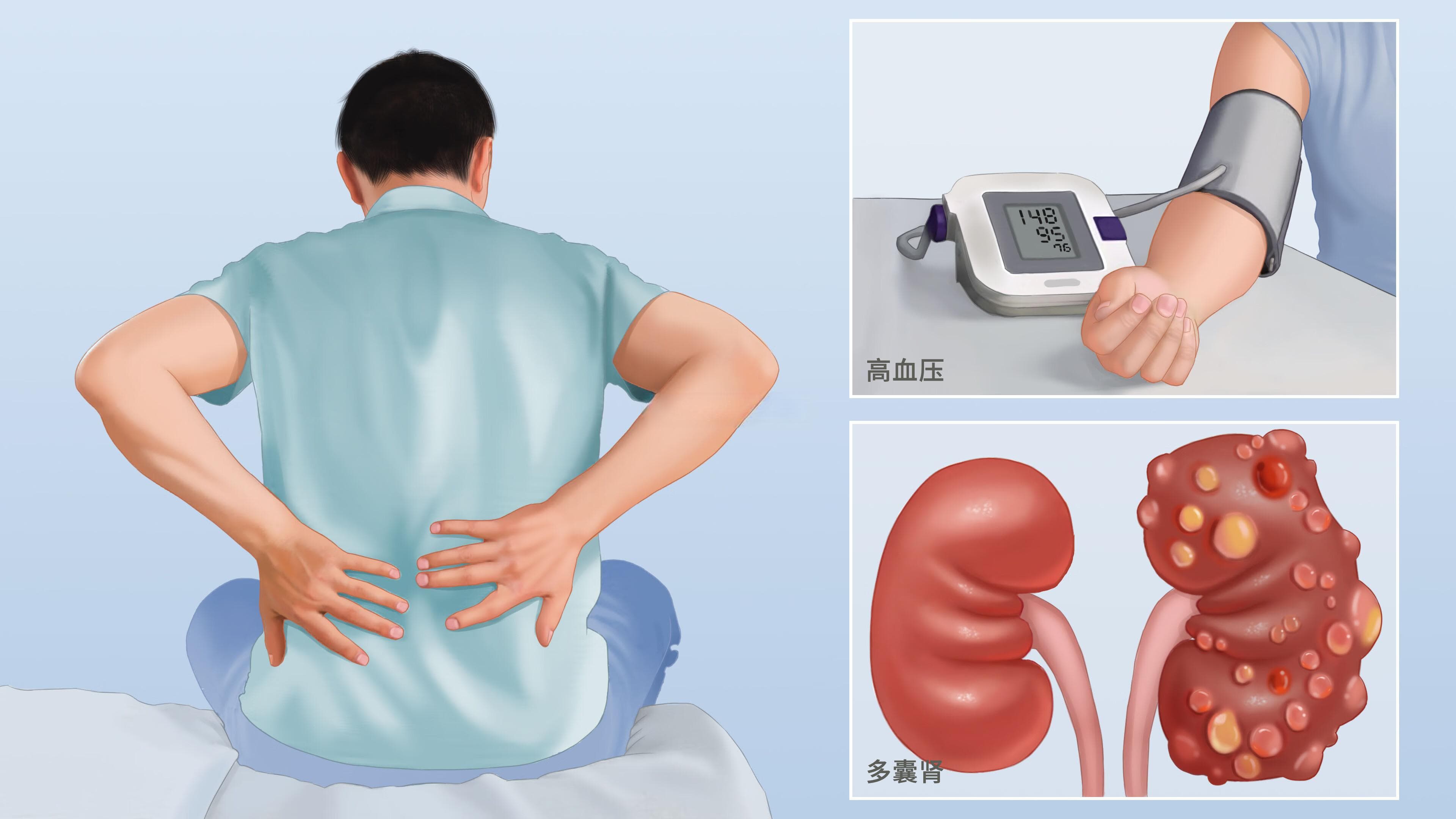 多囊肾：症状、诊断与治疗全解析