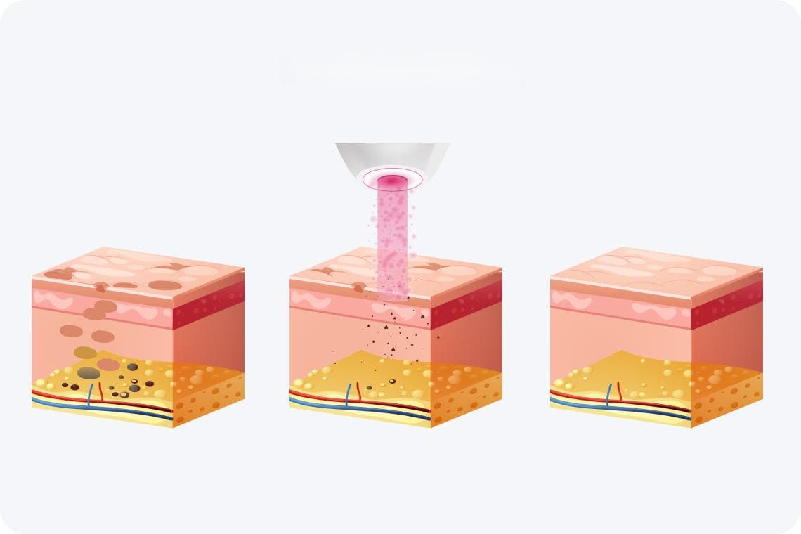 点阵激光做几次才能看到效果