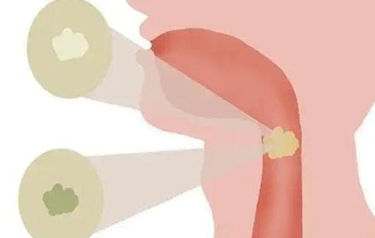 嗓子有“胶水痰”？中医教你化痰润喉，轻松摆脱困扰！
