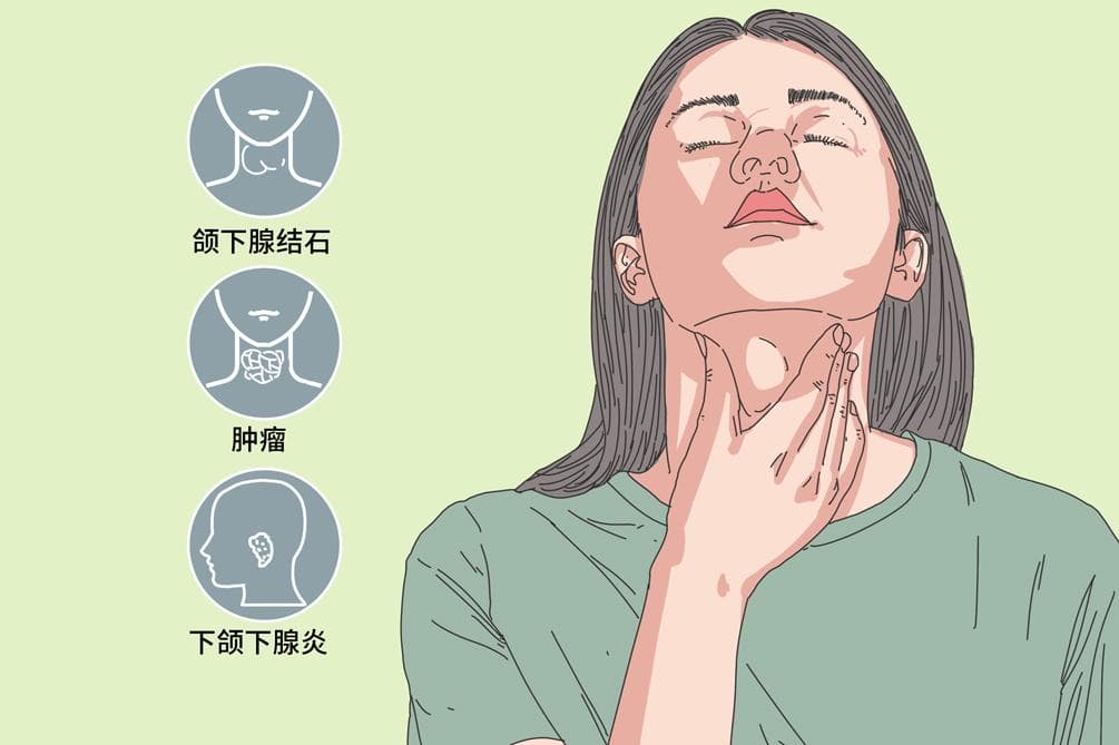 颌下腺肿大