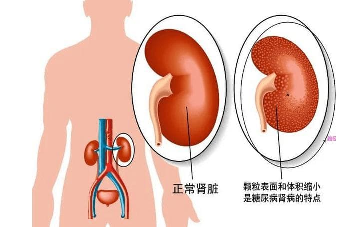 天草纲目：什么是糖尿病肾病？该如何防治？