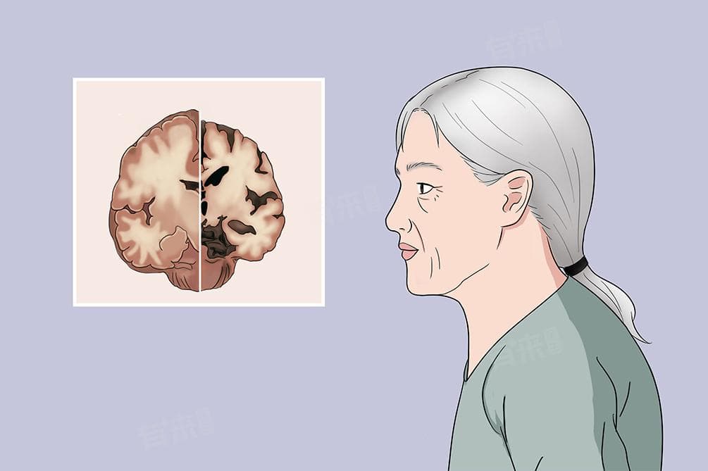 阿尔茨海默病：从病理特征到诊断治疗全解析