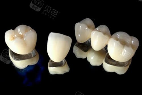 现在镶牙什么类型的好？推荐目前主流的3种类