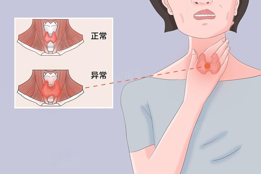 甲状腺癌早期的8个症状