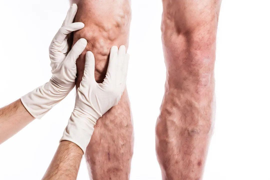 腿痛的元凶居然是肺癌？出现这几种腿部情况要注意