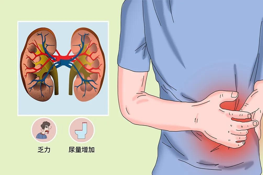 肾功能衰竭症状有哪些