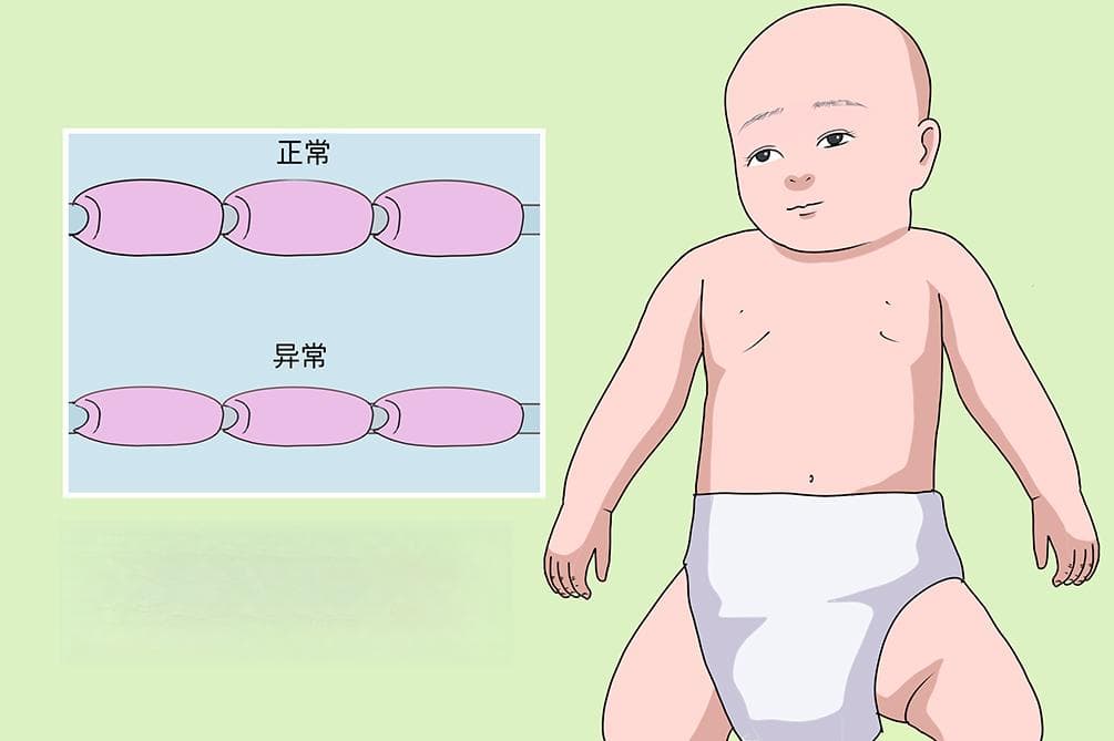 髓鞘发育不良