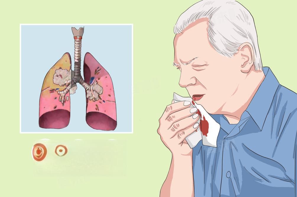 鳞状上皮细胞癌：病因、治疗及预后全解析