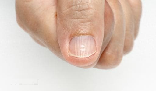 指甲起竖纹是肠胃不好？指甲“月牙”越多越健康？真相是……