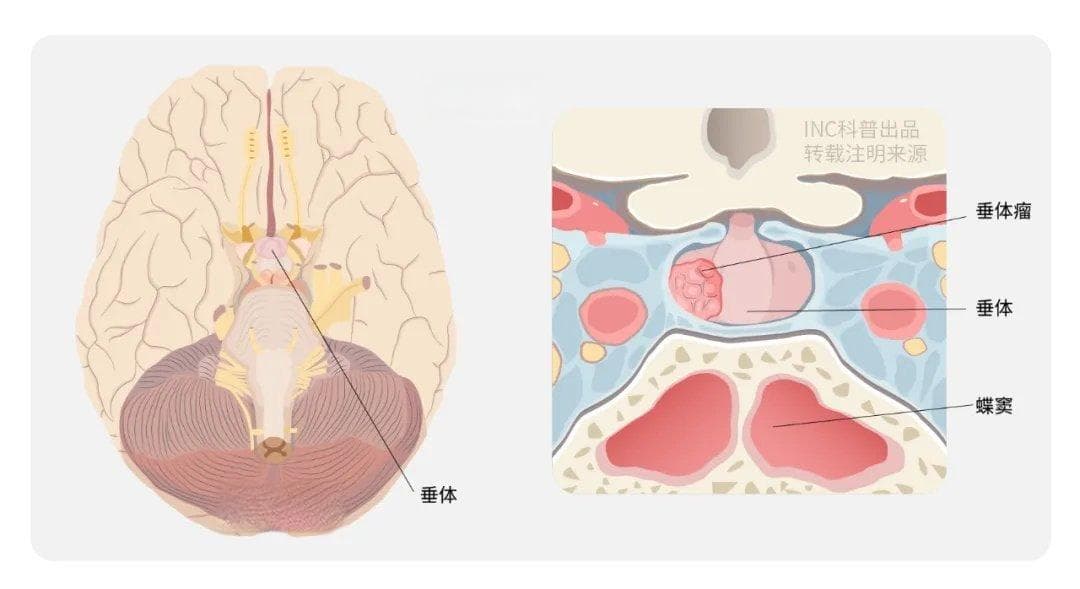 垂体瘤治疗难题：高侵袭性、高复发性，如何应对？8个疑问多方位解答