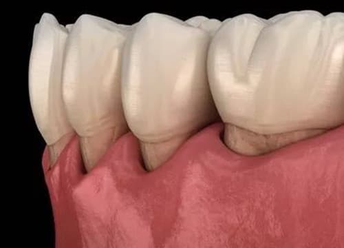牙周袋怎么治疗才有效?牙周袋3到6mm需要做手术吗?牙周袋7mm牙还能保住吗?