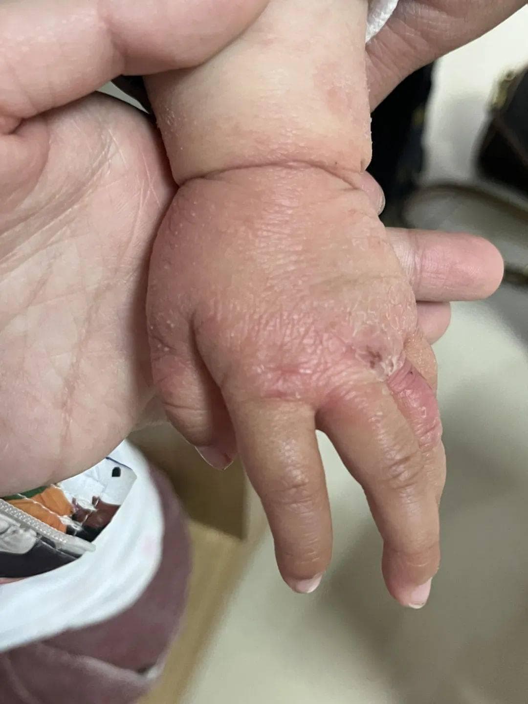 这种皮肤病让人“抓狂”，如何有效防治？