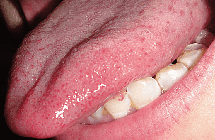 深度解析：舌炎与口腔健康的紧密联系，你了解多少？