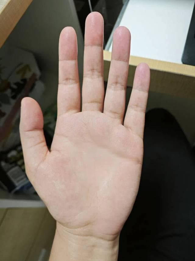 手掌出现这些迹象，可能是肝出了问题