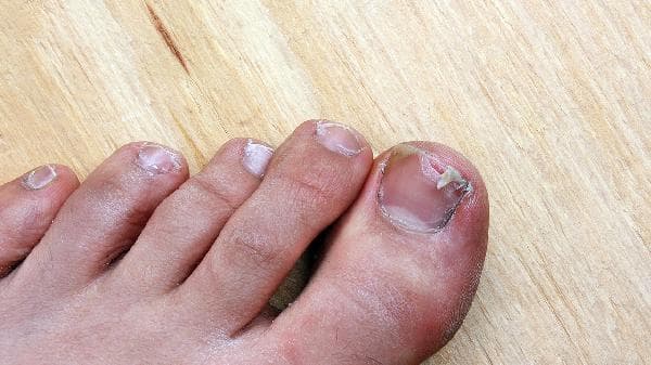 灰指甲：传染原因、预防措施与治疗方法全解析