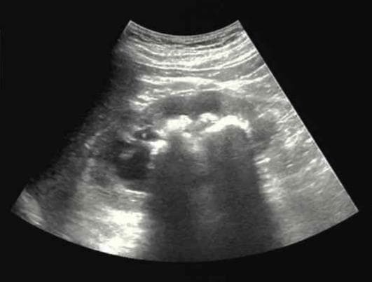 世界肾脏日 | 无声的"透视眼"：超声如何守护你的肾健康？