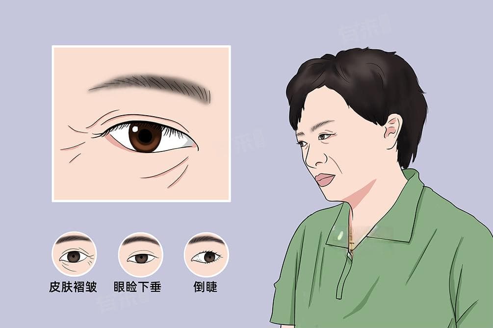眼睑下垂是什么原因导致的