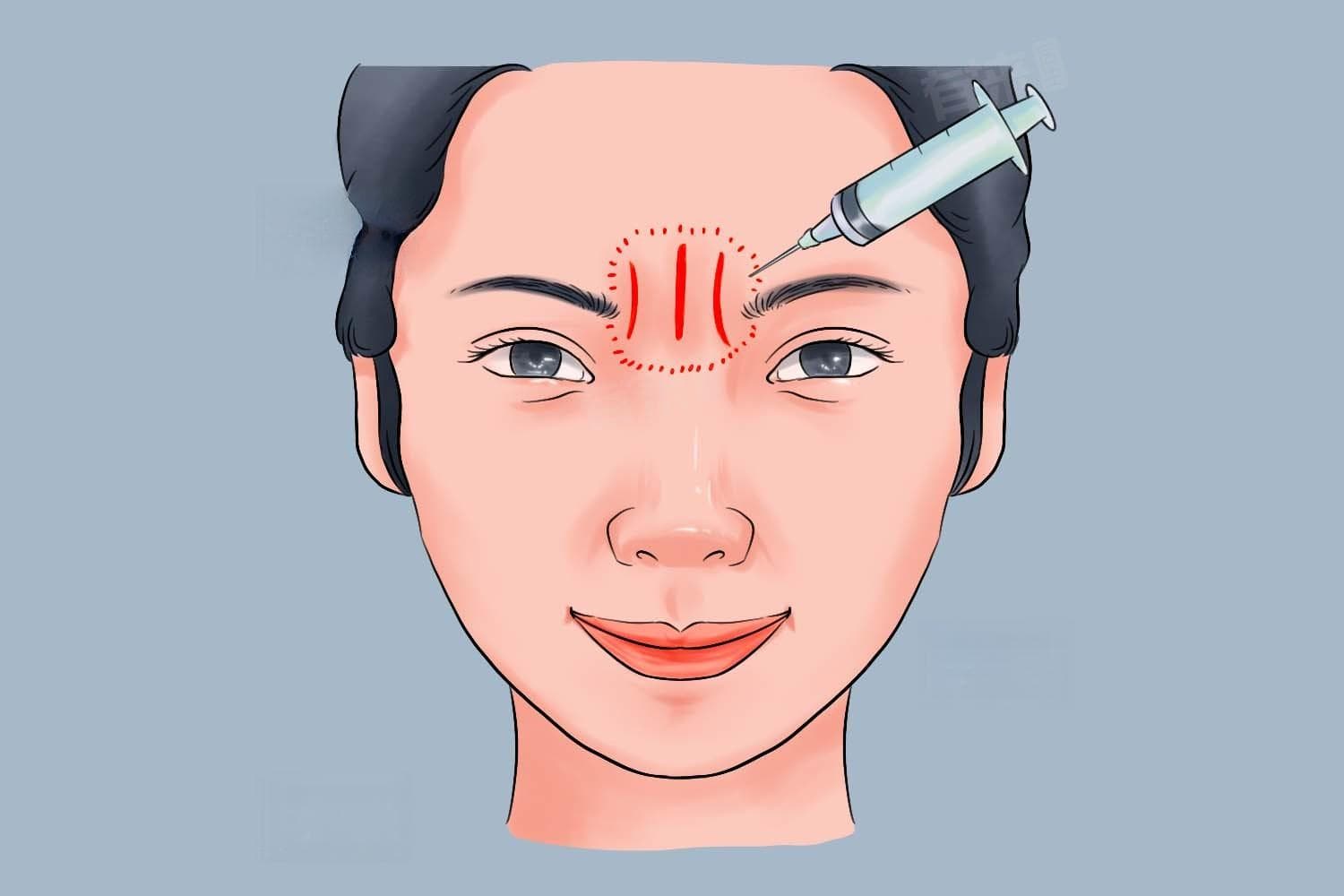 肉毒素中毒的处理方法