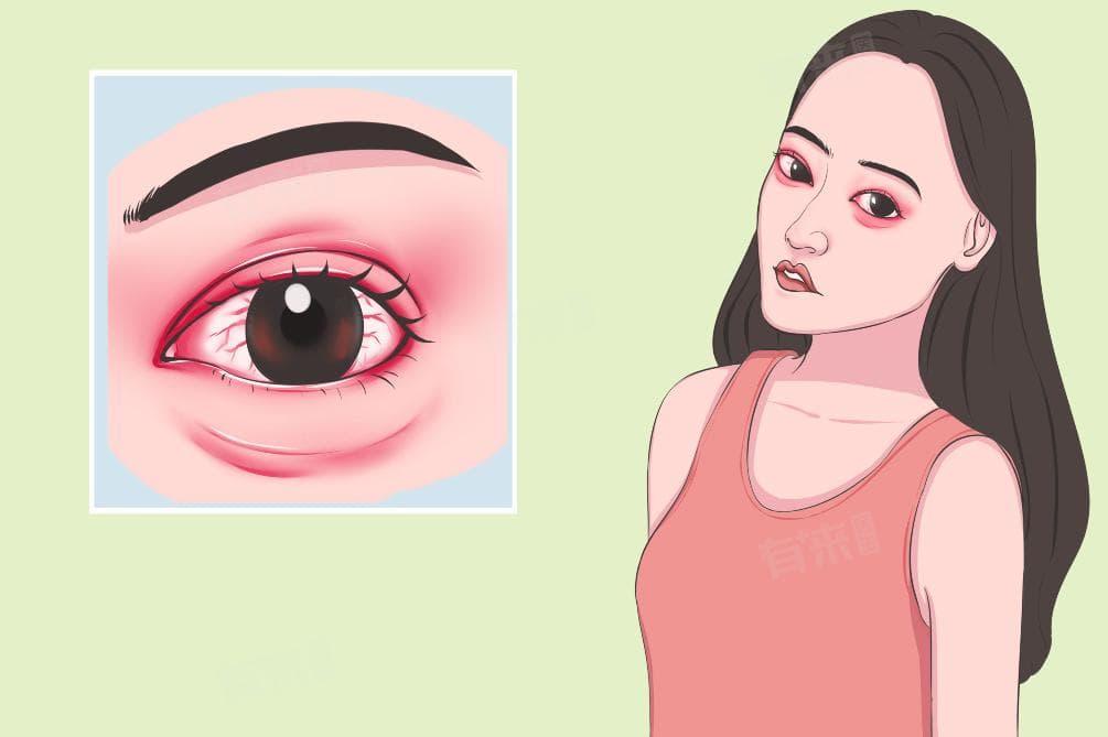红眼病怎么治好得快