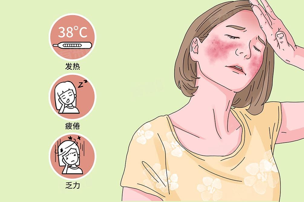 结缔组织病要注意什么