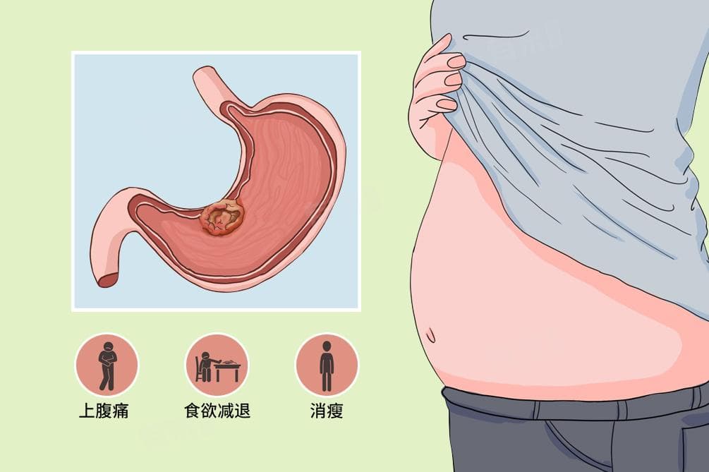 晚期胃癌的治疗与护理指南