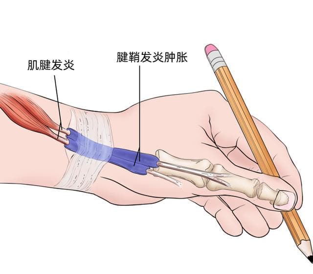 大拇指疼痛，腱鞘炎多久能好，会不会发展成关节炎？