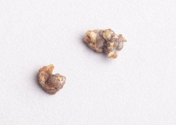 胆囊结石泥沙型怎么调节