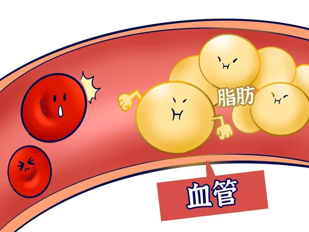 高血脂可以通过透析降血脂吗？