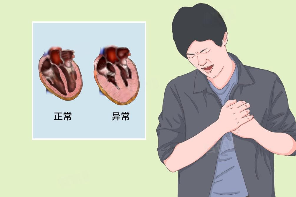 肥厚型心肌病的治疗方法和体征特点