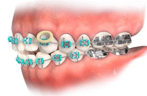 二类牵引在牙齿矫正中的应用：原理、操作与注意事项