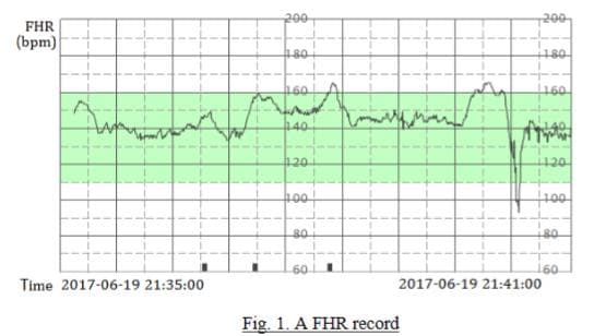 基于胎心仪数据的胎儿心脏诊断神经网络研究