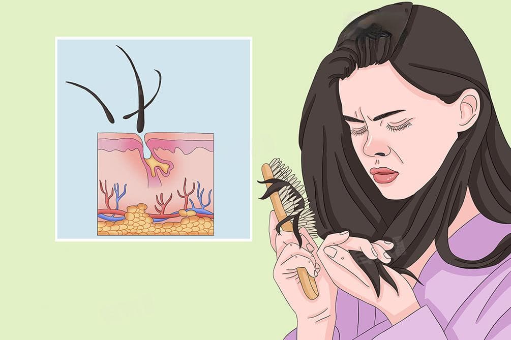 女生脱发严重怎么改善和恢复