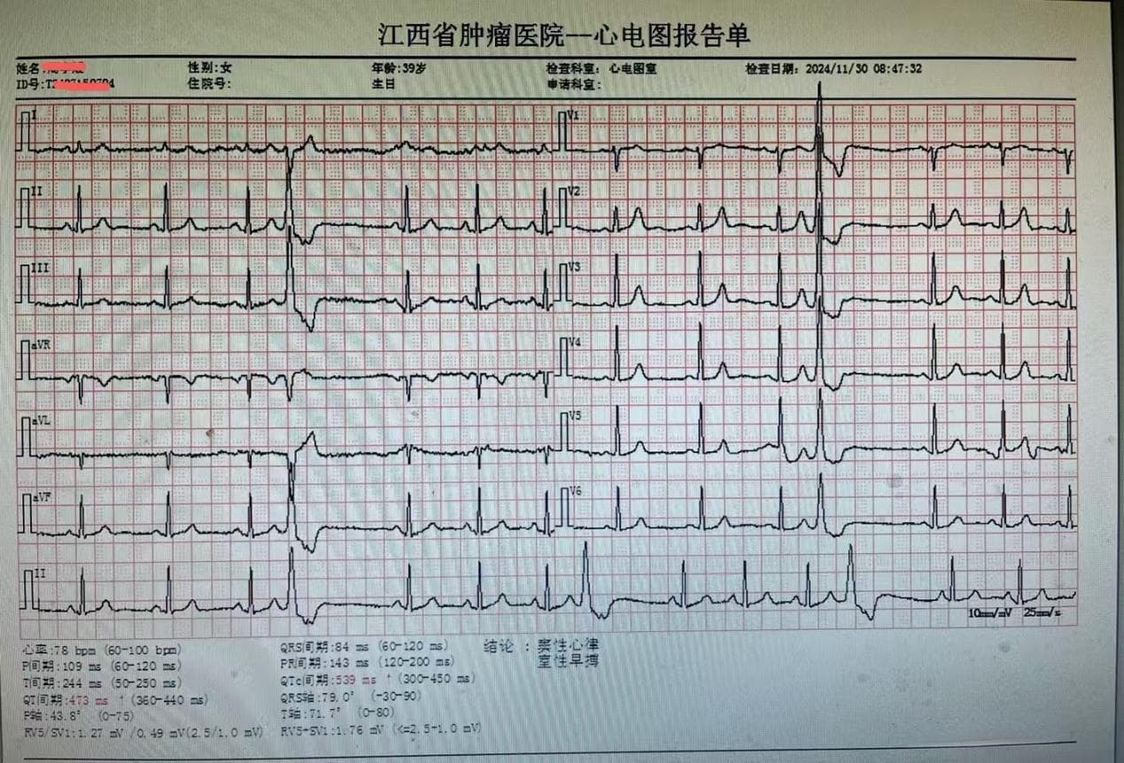 室性早搏可致心力衰竭，专家详解病因与症状