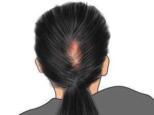 后脑勺阵痛怎么办？三种方法快速缓解疼痛