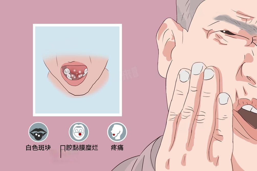 口腔白斑怎么治疗最好