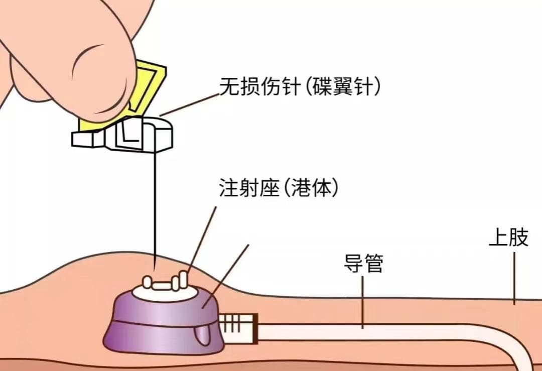 一文读懂静脉输液港：化疗患者福音，可减少95%穿刺次数