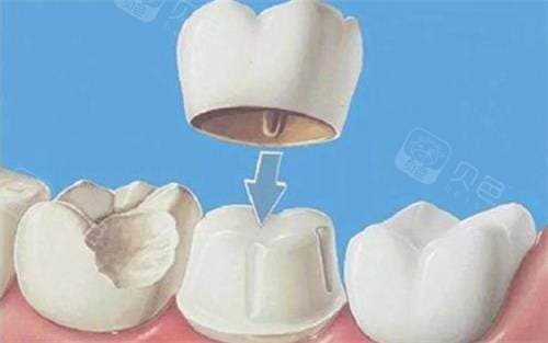 全瓷冠桥是什么意思?集美观与功能于一体的现代牙齿修复方案