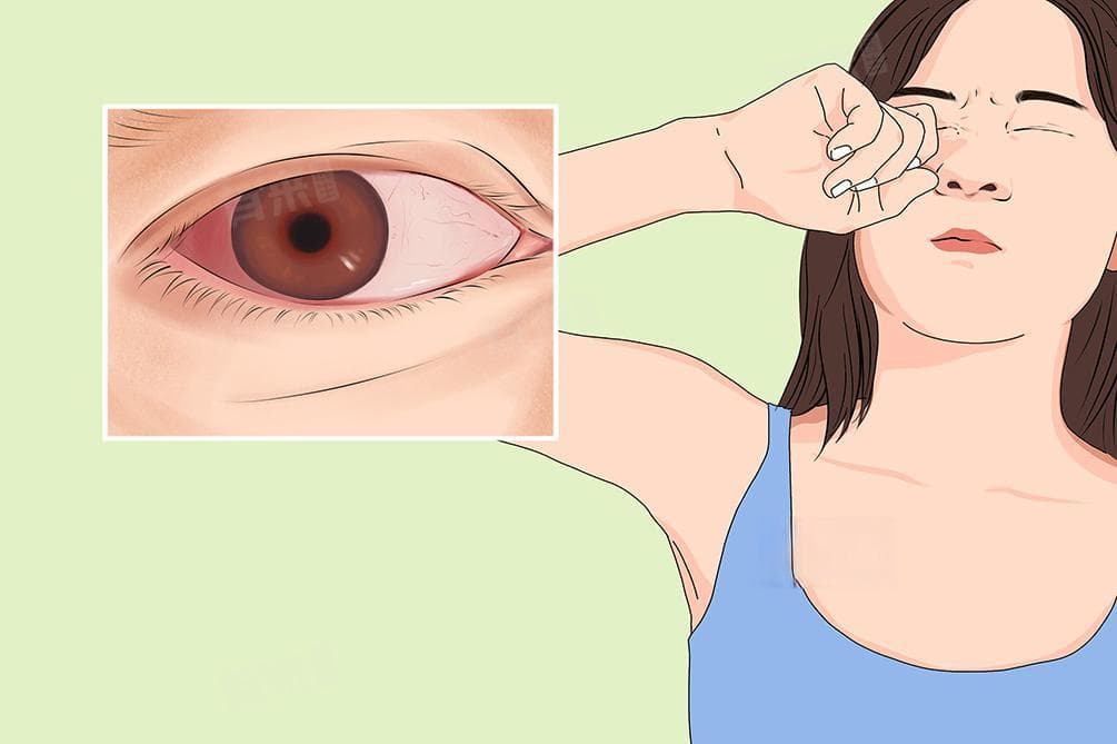 眼睛进异物怎么办？四种科学处理方法详解