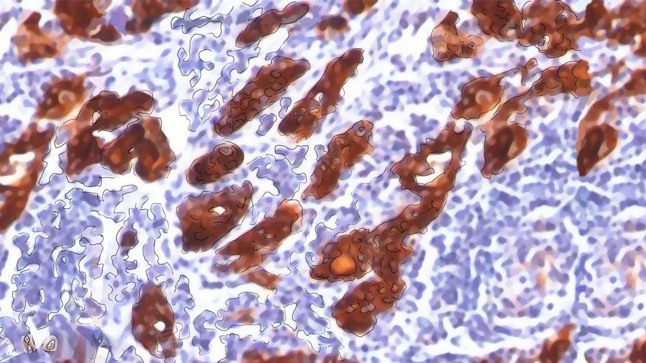 甲状腺球蛋白偏低的原因及护理