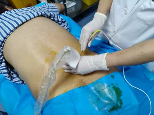 手术后疼痛管理：如何安全有效地缓解