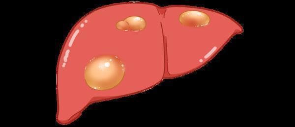 腹腔镜治疗肝囊肿：这些情况最适合做手术