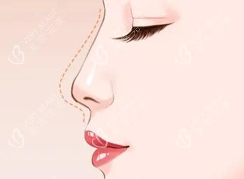 怎么判断自己是不是塌鼻梁？几个实用的判断方式帮你了解鼻型特征